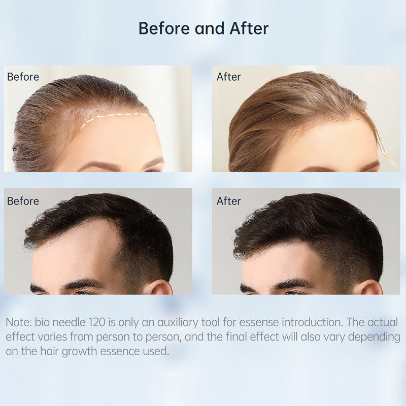 Derma Stamp (For Hair Growth, Stretch Marks, Wrinkles, & Acne Scars)